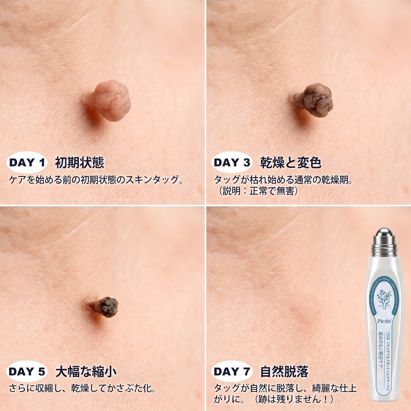 ✅✨公式ブランドストア  𝐏i𝐜𝐝o® 𝟕日間イボ&シミ消し(痛みも傷跡もゼロのローラーボール)
