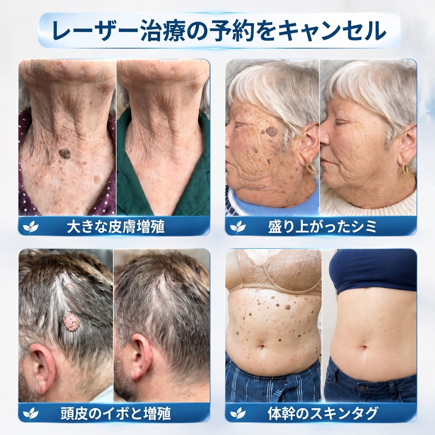 ✅✨公式ブランドストア  𝐏i𝐜𝐝o® 𝟕日間イボ&シミ消し(痛みも傷跡もゼロのローラーボール)