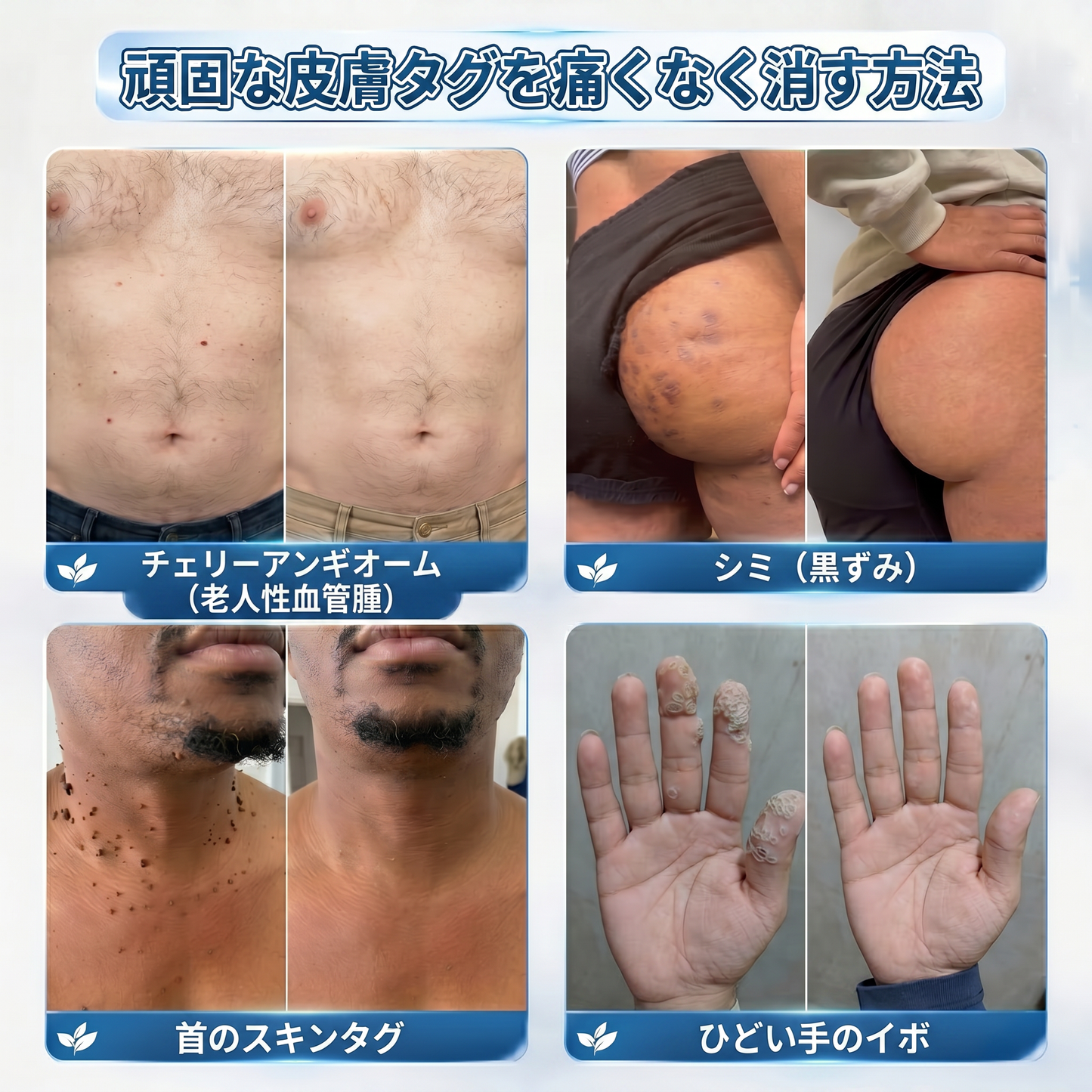 ✅✨公式ブランドストア  𝐏i𝐜𝐝o® 𝟕日間イボ&シミ消し(痛みも傷跡もゼロのローラーボール)